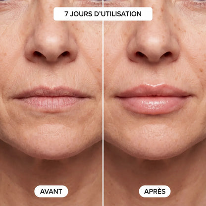 Kit LipBoost - Microneedling Lèvres Neociel™