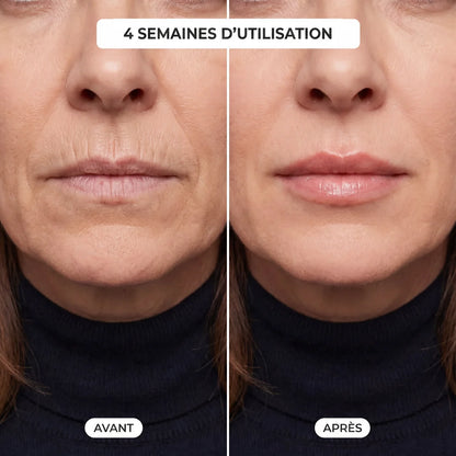 Kit LipBoost - Microneedling Lèvres Neociel™