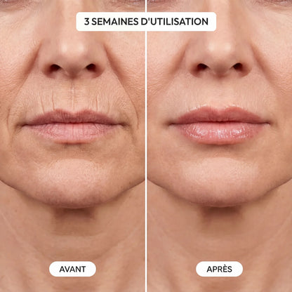Kit LipBoost - Microneedling Lèvres Neociel™